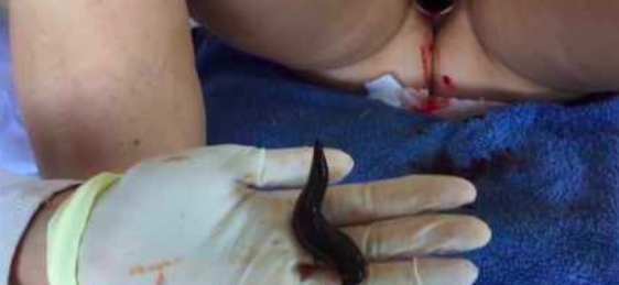 Leech Therapy on a Woman with Tsetsi