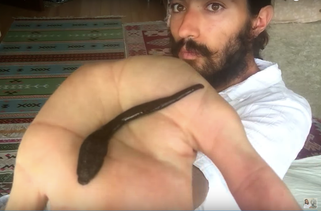 How to Deel with Medical Leeches